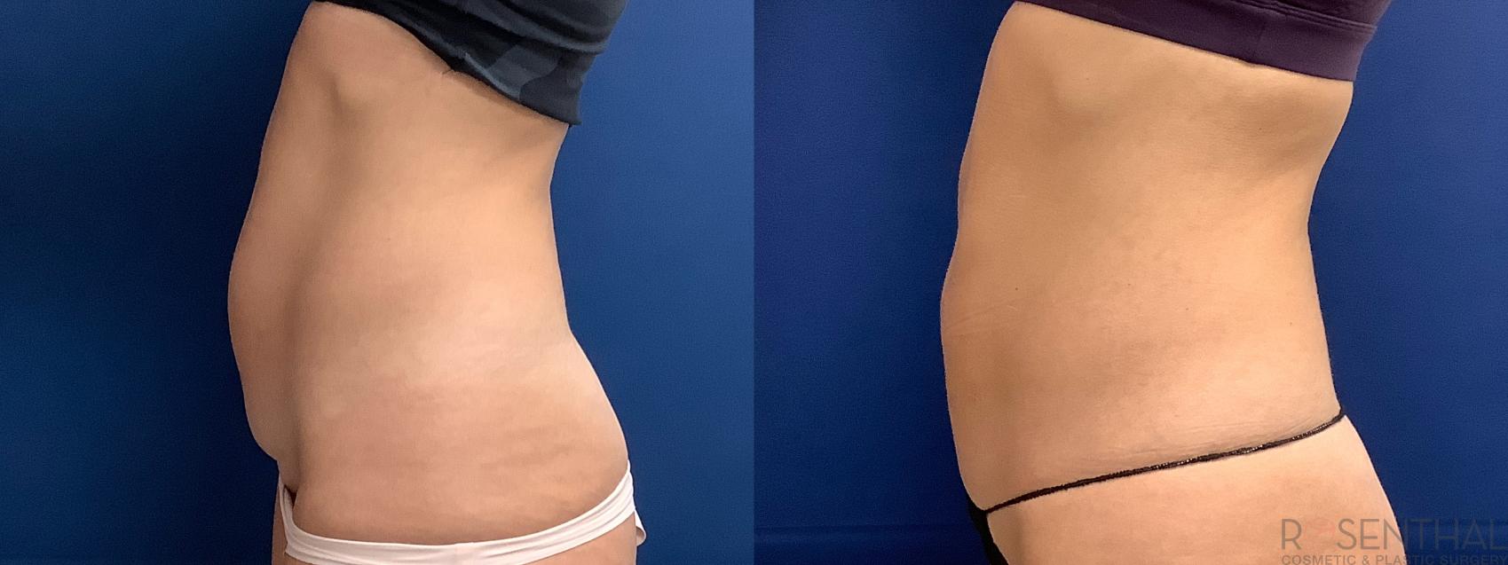 Before & After Tummy Tuck Case 61 Left Side View in Boynton Beach, West Palm Beach, FL