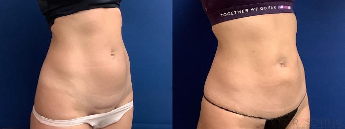 Before & After Tummy Tuck Case 61 Right Oblique View in Boynton Beach, West Palm Beach, FL