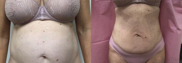 Before & After Tummy Tuck Case 62 Front View in Boynton Beach, West Palm Beach, FL