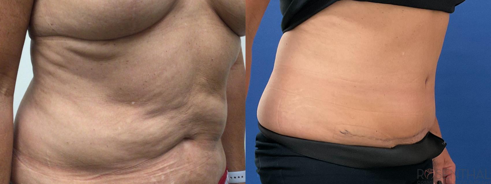 Before & After Tummy Tuck Case 63 Right Oblique View in Boynton Beach, West Palm Beach, FL